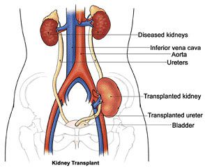 cost of incompatible kidney transplant india