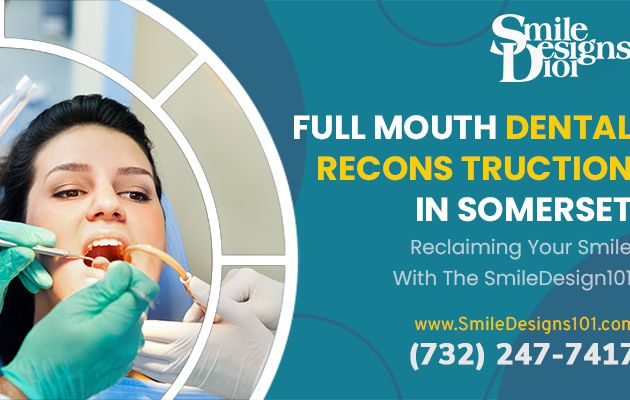 The Benefits of Full Mouth Dental Reconstruction with SmileDesigns101 in Somerset