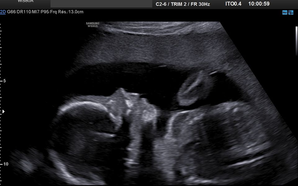 consistance du col si je suis enceinte. - My Sweet little baby et ...