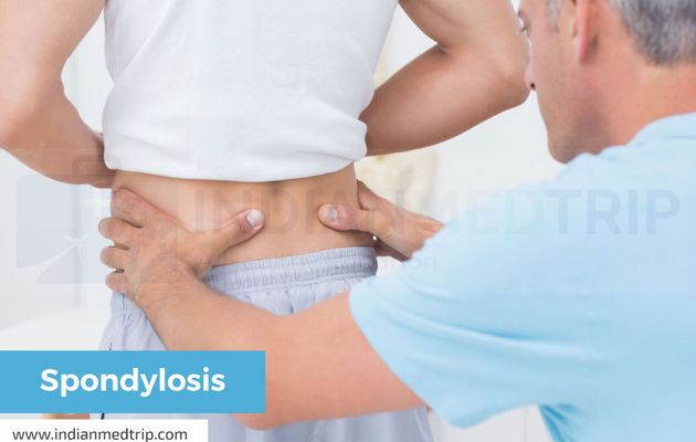 Spondylosis Causes, Symptoms & Treatment