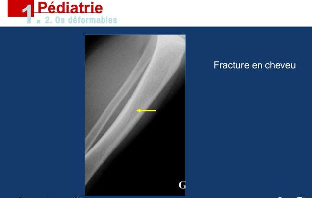 Fracture en cheveux