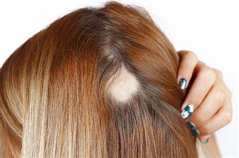 Una guía completa sobre cómo las mujeres pueden recuperar el cabello perdido