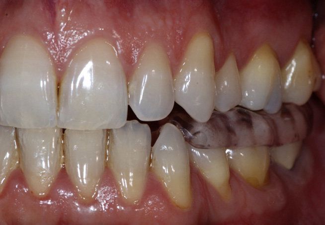 Les dérives des gouttières dentaires inquiètent les orthodontistes