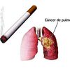 MSS alerta sobre prevención del cáncer pulmonar