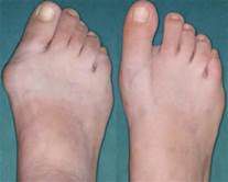 Bunion Relief