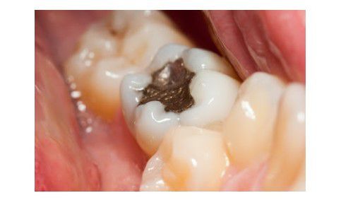 【2018】Trám răng bằng amalgam ?? 4 ví dụ sau sẽ làm bạn "thức tỉnh"