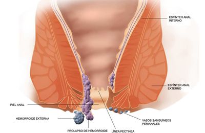 Cirugía de hemorroides: en qué consiste