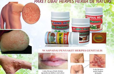 Semak disini,  Pengobatan Herpes Zoster Malaysia - Pakej ubat herba De Nature