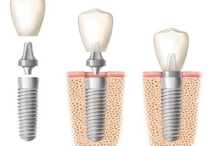 What one needs to know about dental implants and its procedure?