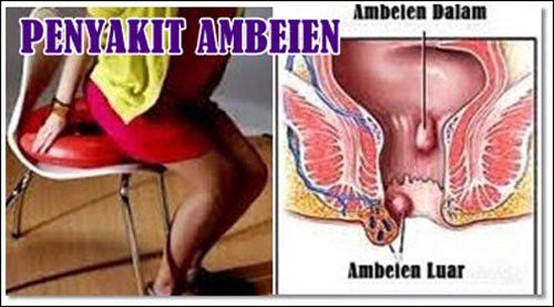 Obat Ampuh Ambeien Luar