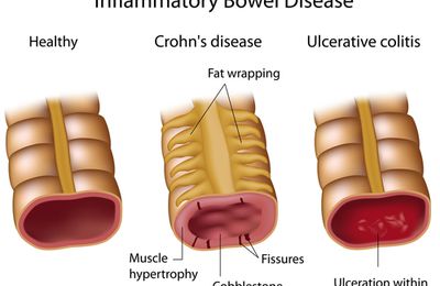 Ulcerative Colitis Therapeutics Market to Grow, thanks to Strong Pipeline of Therapeutic Products