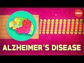 Alzheimer: des dommages au cerveau plus tôt que prévu