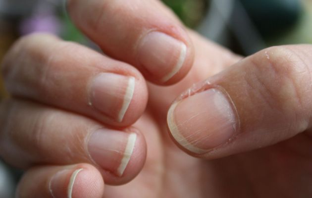 Stries sur les ongles causes