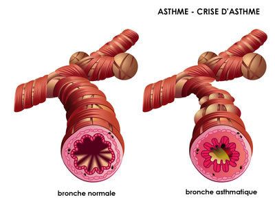 L’ASTHME