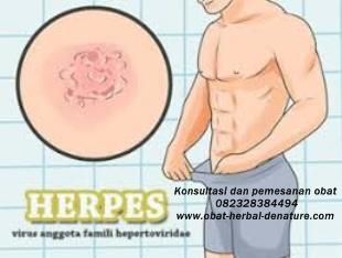 Obat Herpes Kelamin De Nature