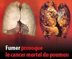Cancer du poumon : Les anciens fumeurs passent à travers les mailles du dépistage