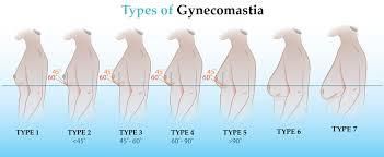 WHAT IS GYNECOMASTY?