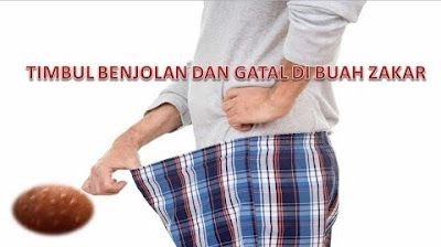 jual obat alami untuk mengatasi gatal buah zakar