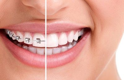 Are Orthodontic Appliances Suitable For Any Age?