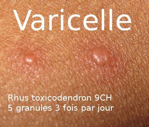 Varicelle : soulager et atténuer les cicatrices