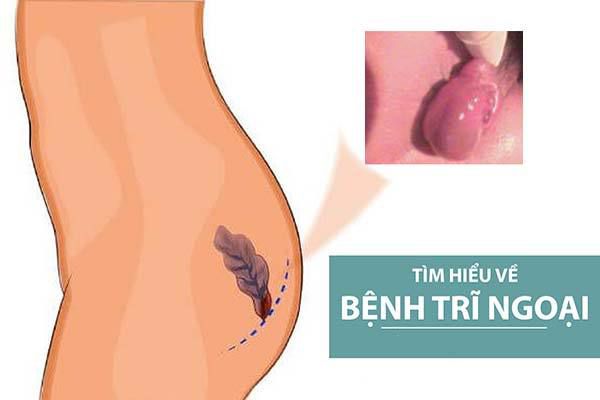 Bệnh Trĩ Ngoại: Nguyên nhân, triệu chứng và Cách điều trị hiệu quả