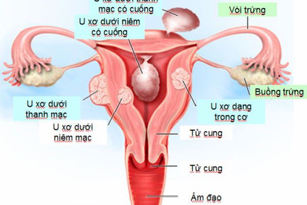 Những biến chứng của bệnh u xơ tử cung