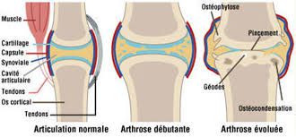 Arthrose et douleurs articulaires, les produits Forever peuvent vous soulager. 