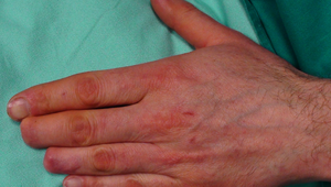 Allungamento contemporaneo di due dita (medio e anulare) della mano sin