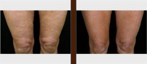Best Results from the Advanced Cellulite Treatment in Adelaide