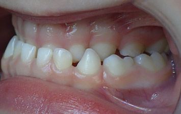 Orthodontie dents du bas