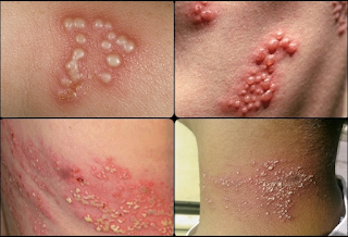 Obat Penyakit Herpes Manjur