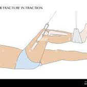 LES TRACTIONS CONTINUES - Formation AS