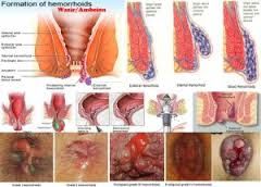 Cara Mengatasi Wasir Stadium 3 Pada Wanita