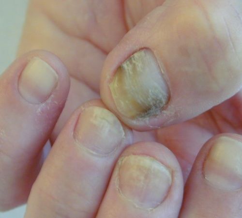 Les Differentes Maladies De L Ongle Enaary Nail Art