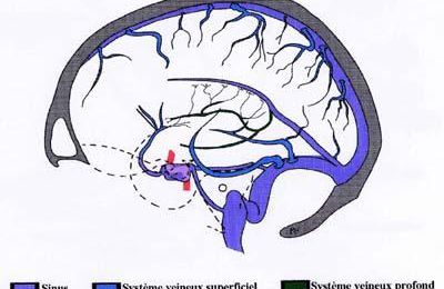 La thrombophlébite cérébrale