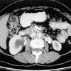 Fibrosis Retroperitoneal Idiopática (enfermedad de Ormond)