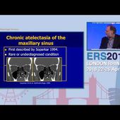 ERS London 2018, P Eloy, Silent Sinus Syndrome