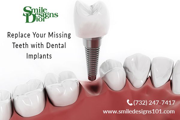 4 Reasons to Choose Dental Implants for Missing Teeth