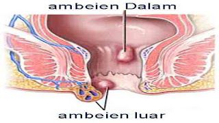 Cara mengobati muncul benjolan pada anus tapi tidak sakit