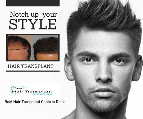 Best Hair Transplant Surgery FAQ