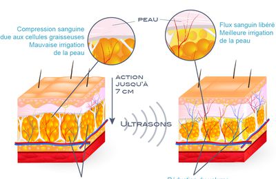 Amincissement de la peau