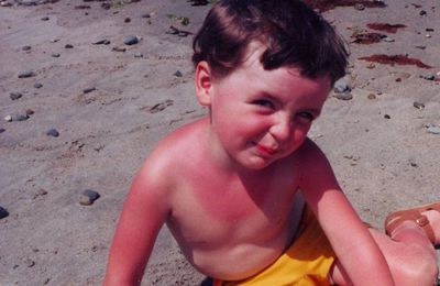 All about prevention and treatment of: Sunburn