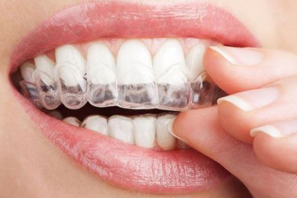 【Review 2018】Kinh nghiệm niềng răng không mắc cài Invisalign