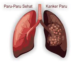 PENYEBAB DAN MENGATASI KANKER PARU PARU DENGAN OBAT HERBAL DI APOTIK UMUM