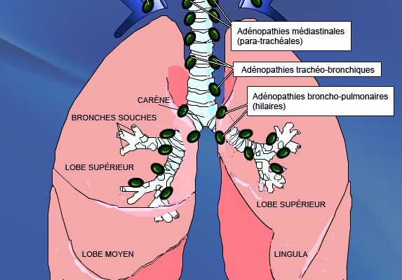 Drain poumon cancer