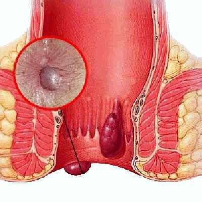 Obat Wasir Dari Luar