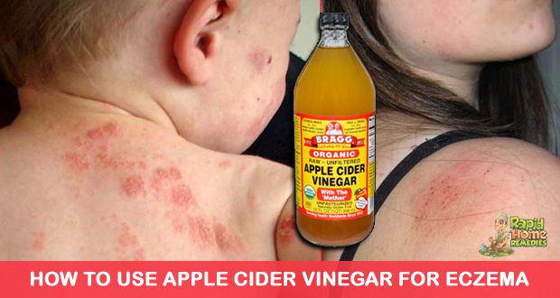 Comment faire pour utiliser du vinaigre de cidre pour l'eczéma