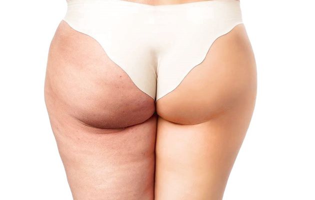 Come funziona la crema riducente per cellulite con CLA CARNITINA