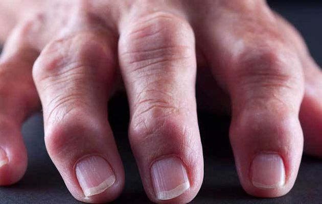 Rheumatoid Arthritis Market Dynamics, Comprehensive Analysis, Business Growth, Prospects and Opportunities by 2022