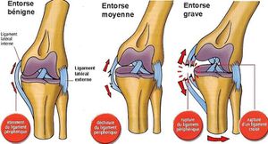 Définition d'une entorse